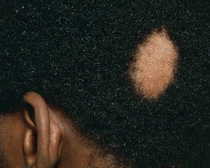 Alopecia-Areata-Afro-Caribbean