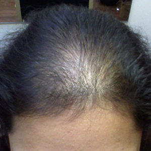 diffused-hair-loss