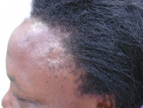 traction-alopecia-african-girl